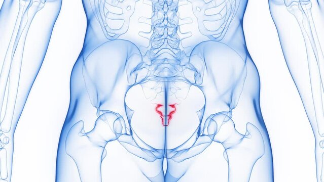 Animation of inflammation of man's coccyx