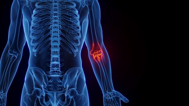 Animation of arthritis of the left elbow