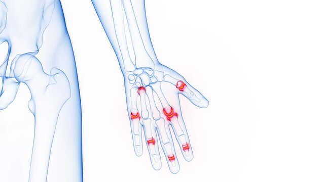 Animation of male skeleton with inflamed hand