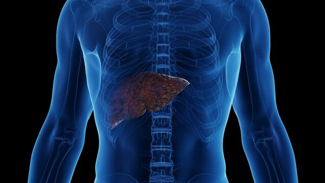 Animation of a man's cirrhotic liver