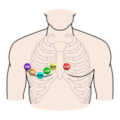 Right Sided ECG Electrode Placement - Electrocardiogram Lead V1R, V2R, V3R, V4R, V5R, V6R Positions - Medical Vector Illustration
