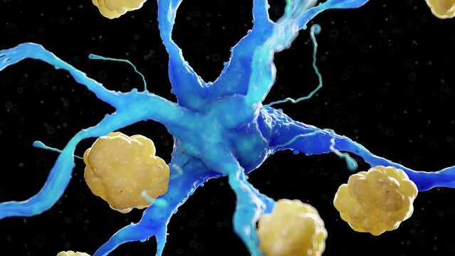 Animation of a nerve cell affected by amyloidosis