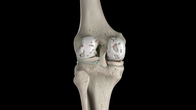 Animation of damaged knee cartilage