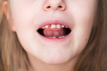 portrait of a little child girl moving her milk front tooth with her tongue in open mouth.
