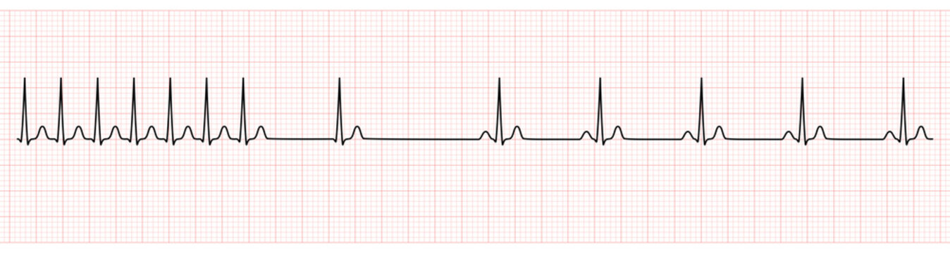EKG Monitor Showing  Supraventricular Tachycardia Change to Sinus Rhythm After Adenosine Injection