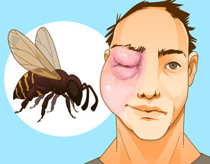 Bee sting. Swollen face. Swollen eye. Injury after a bee sting.  Redness on the skin. Closeup illustration. Healthcare illustration, vector illustration. 