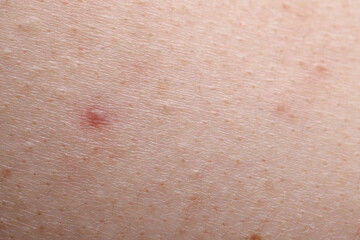 Fototapeta premium Young person with acne problem, closeup view of skin