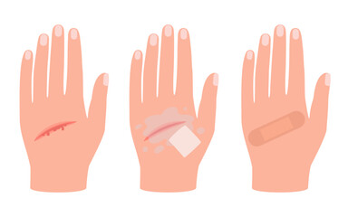 Wound of hand human skin, scratch. First aid for cut injury skin, bleeding cut. Clean and disinfection wound, patch for safe health. Vector