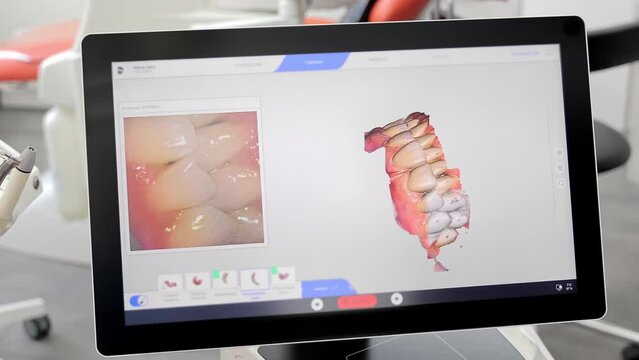 3D scanning of teeth. Looking at the screen and scanning the dental jaw in 3D space. Modern dentistry.