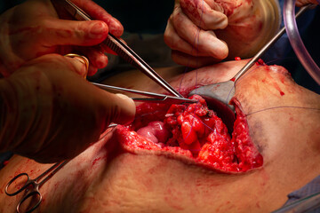 Surgical operation, closeup on operating field and hands of surgeons