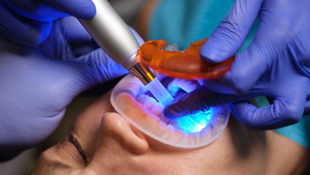 Restoration Of Teeth With Filling-polymerization Lamp. Dental Light-curing Composite Resin