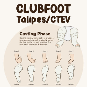 Art vector of clubfoot. Ponseti Method. Foot turn inward or upward. Clubfoot phase for casting infographic