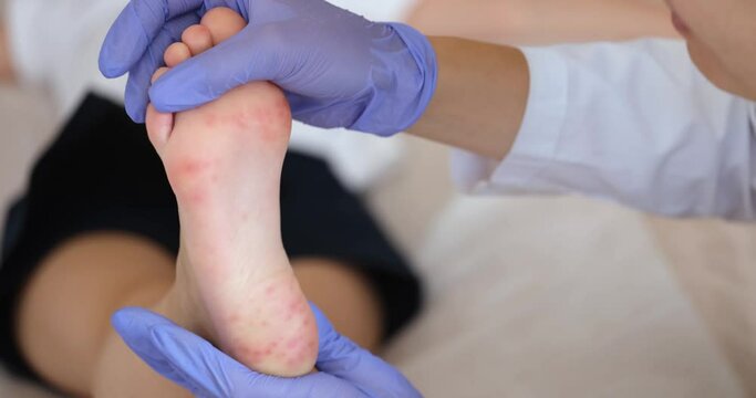 Doctor dermatologist examining red rash on feet of child closeup 4k movie. Chickenpox treatment concept