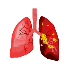 Lung cancer is a type of cancer that begins in the lungs. Your lungs are two spongy organs in your chest that take in oxygen when you inhale and release carbon dioxide when you exhale.