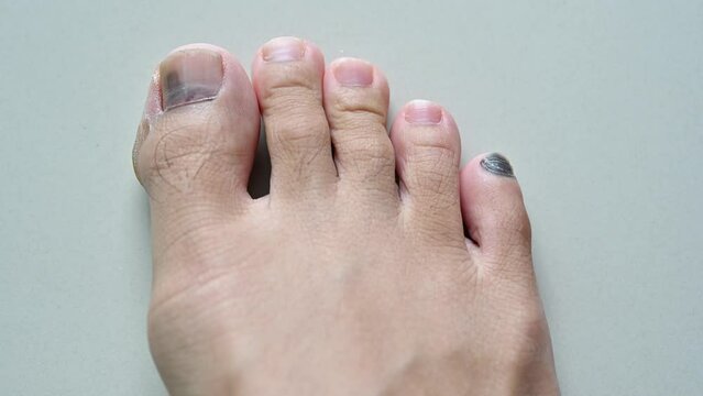 Man moving his black nail occur after running. Runner's Toe can be described as toenail damage, and would occur when the toe is rubbing against the front of the shoe.