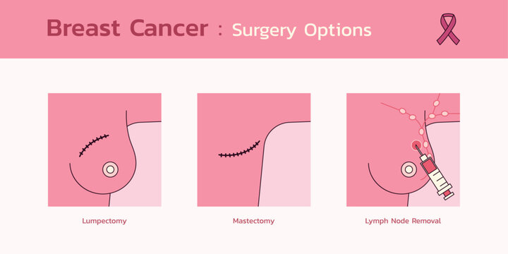 Breast Cancer Surgery Options, A Comprehensive Infographic on Treatment Choices and Decision Making, Vector Flat Design Medical Illustration
