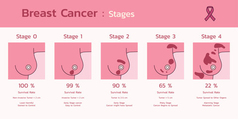 Medical Infographic, Navigating Breast Cancer Stages for Informed Decisions and Awareness, Vector Flat Design Illustration - obrazy, fototapety, plakaty