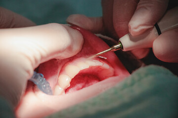 Radiant Smile During Dental treatment