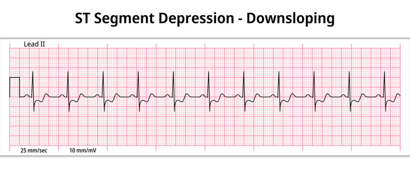 ECG ST Segment Depression - Downsloping - 8 Second ECG Paper - Electrocardiogram Vector Medical Illustration