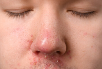 Young man with acne problem, closeup view