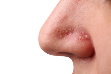 Fototapeta premium Young woman with acne problem on grey background, closeup