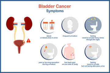 medical vector illustration infographic bladder cancer, bladder cancer symptoms In flat style.Vector illustration of human bladder with cancer on white background.