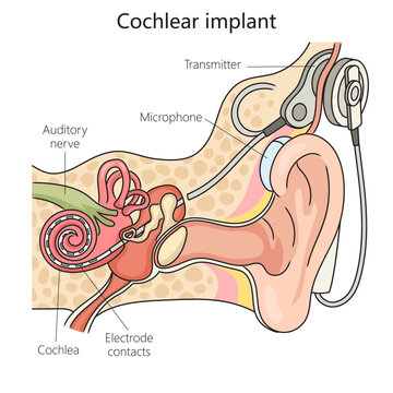 Cochlear implant structure vertebral column diagram schematic vector illustration. Medical science educational illustration