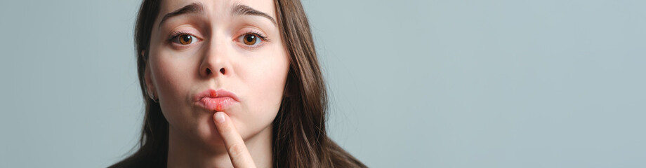 Virus herpes on lips close-up. Unhappy woman points to the painful swollen lips. Portrait of young...