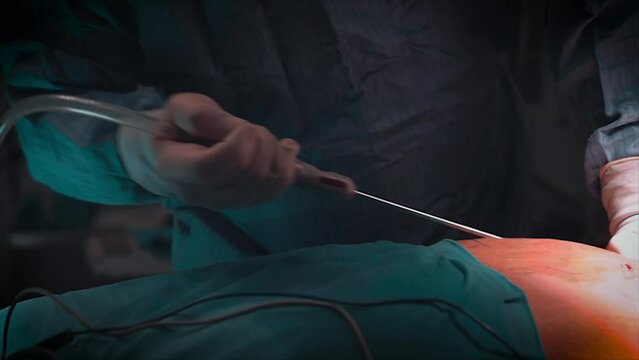 Surgical liposuction tummy tuck.