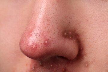 Young man with acne problem, closeup view of nose