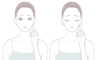 マスクニキビに悩む女性