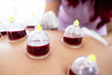 Alternative medicine for pain relief and relaxation. Professional therapist performing hijama...