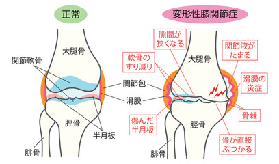 正常な膝関節と変形性膝関節症の比較説明イラスト