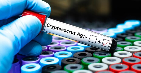 Obraz premium Blood sample of patient positive test for cryptococcus Ag.