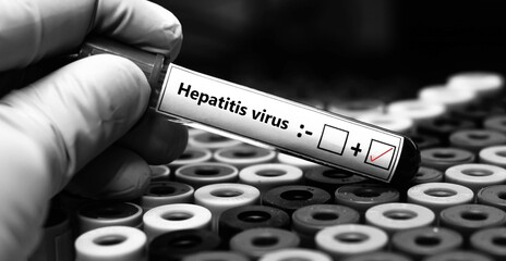 blood sample of patient positive for hepatitis virus.
