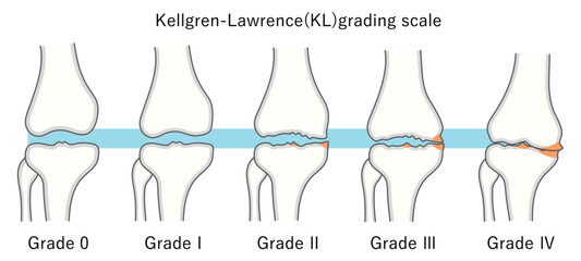 変形性膝関節症の進行度(Kellgren-Lawrence分類)のイラスト