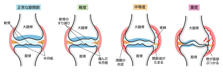 変形性膝関節症のシンプルな進行度別説明イラスト
