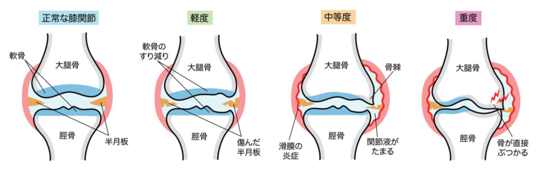 変形性膝関節症のシンプルな進行度別説明イラスト