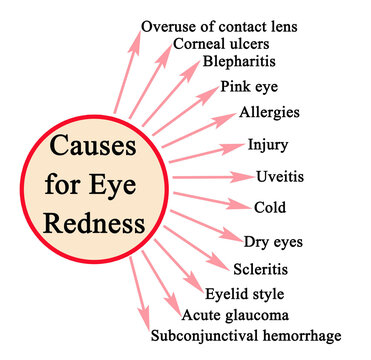 13 Causes for Eye Redness