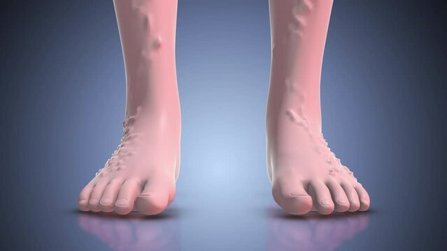 The concept of human varicose veins. 