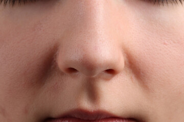 Young woman with acne problem, closeup view