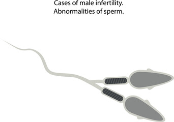Abnormalities of sperm.
