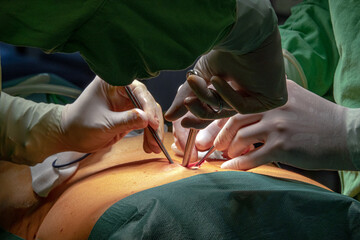 Preparing the patient for endoscopic surgery. Medical team of surgeons in the hospital who perform...