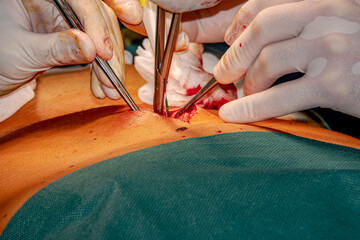 Preparing the patient for endoscopic surgery. Medical team of surgeons in the hospital who perform...