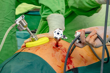 Preparing the patient for endoscopic surgery. Medical team of surgeons in the hospital who perform...