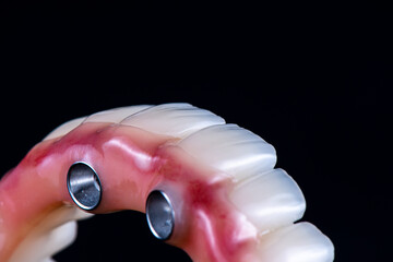 dental photography of full arch zircon bridge on implants
