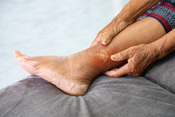 Asian elderly woman holding hands on her leg with gangrene due to diabetes, health care concept and...