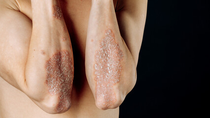 Acute psoriasis on the elbows is an autoimmune incurable dermatological skin disease. A large red,...
