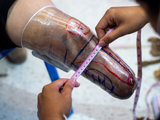 Medical personnel measuring amputated leg to make a prosthetic leg..