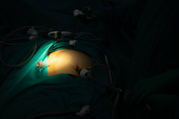 minimal invasive laparoscopic cholecystectomy surgery